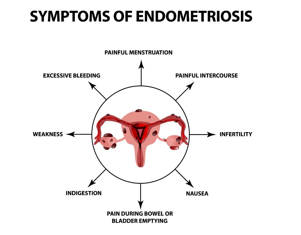 Эндометриоз И Лишний Вес