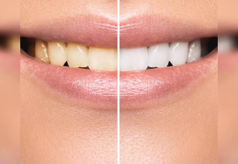 Four tips to get natural looking white teeth 