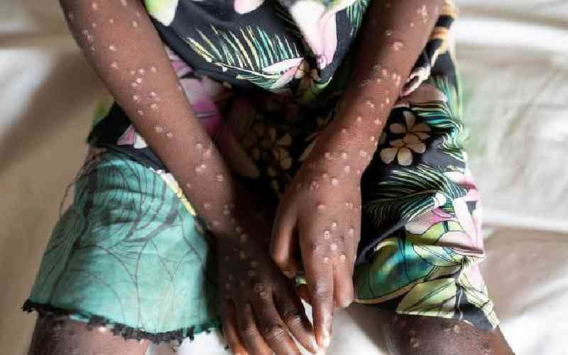 Understanding Monkeypox: Cause, symptoms and treatment