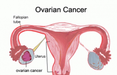 Ovarian cancer deaths could drop by 20% with annual blood test