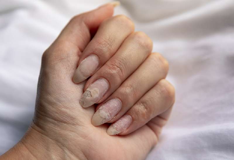 What It Means When You Have Peeling Nails And How To Fix Them Eve Woman