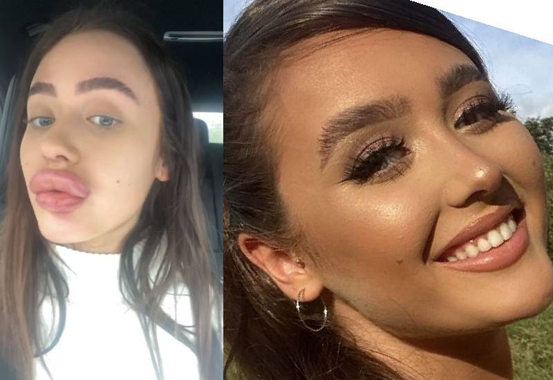 Woman Forced To Hide At Home After Lip Filler Fail Left Her With 