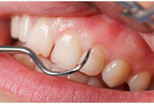 Eight Home Remedies To Get Rid Of Swollen Gums Eve Woman