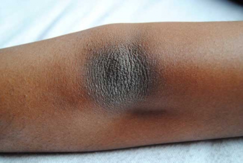 How to get rid of dark elbows and knees naturally - Eve Woman