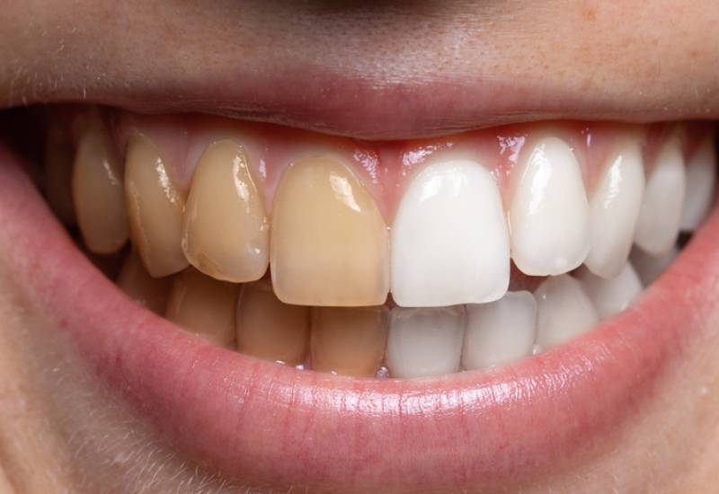 Five common foods that could be staining your teeth