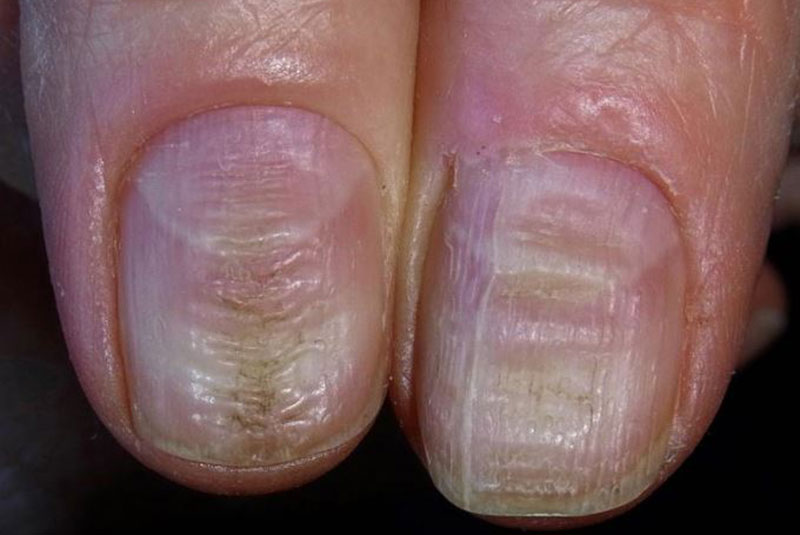 ridges-in-fingernails-symptoms-causes-and-treatments