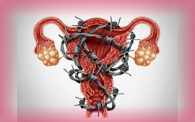 How to tell the difference between bad cramps and endometriosis