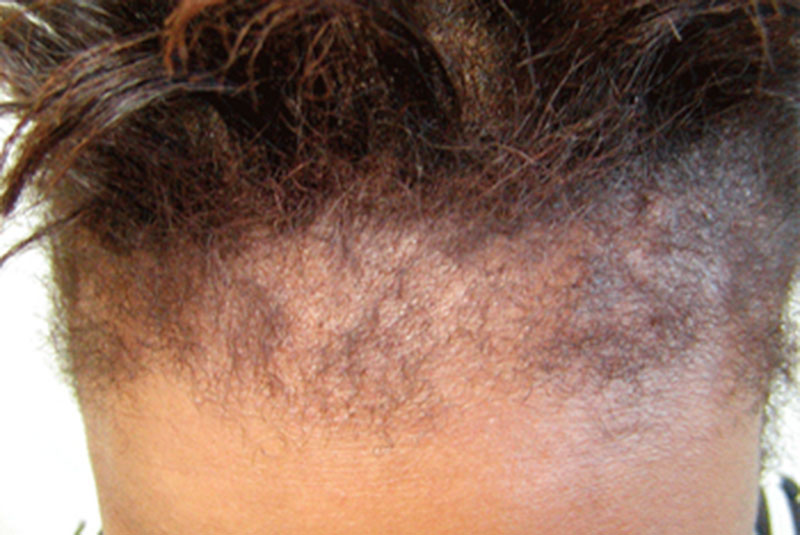 six-common-causes-of-hair-loss-in-women-eve-woman