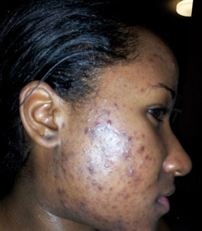 What Causes Acne And How Can You Reduce Pimples And Blemishes On Your Face Eve Woman