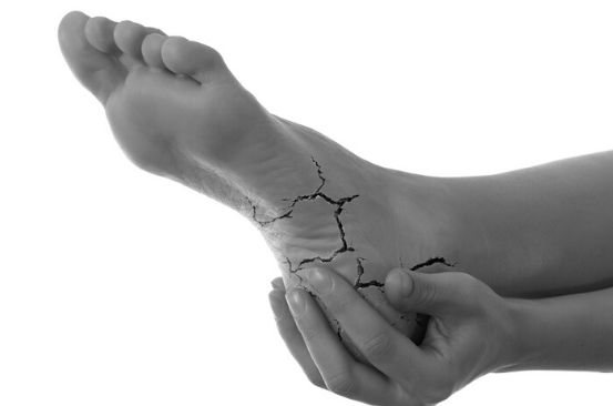 home remedies for cracked feet and hands