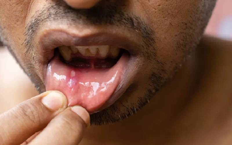 Canker sores: When your mouth speaks about your health