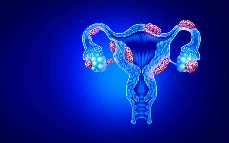 Understanding Endometriosis