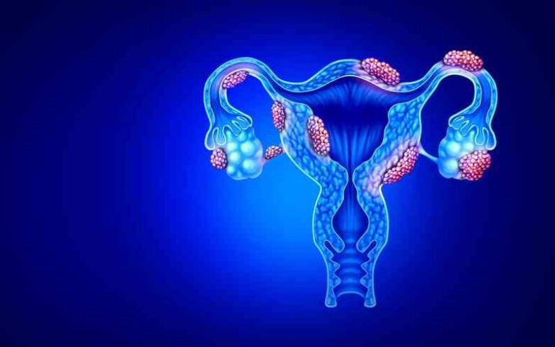 Relief or motherhood: Tough choice endometriosis forces on women