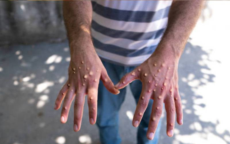 Silent spread: Mpox infections rise as awareness slumps