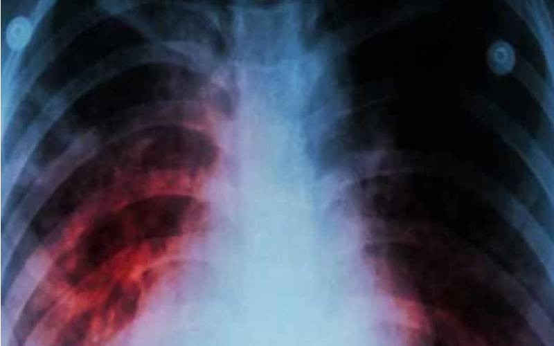 From spinal TB to ICU: How sitting in one position almost killed me