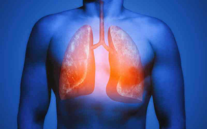 Why lung cancer diagnoses are often delayed in the country