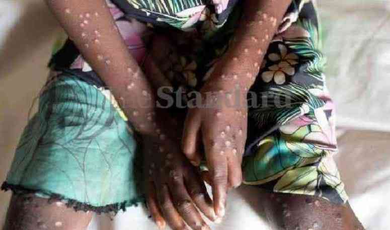 New Mpox case confirmed in Kenya as total rises to nine