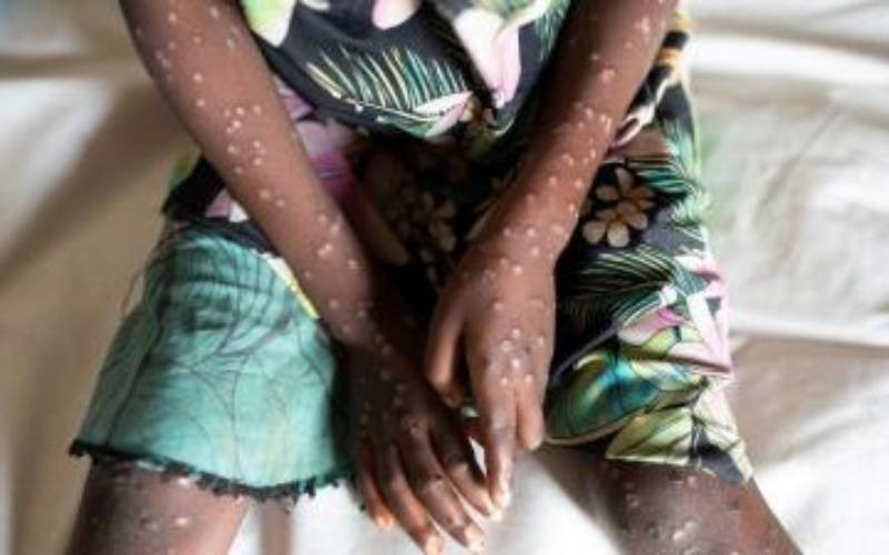 Two more Mpox Cases confirmed in Kenya