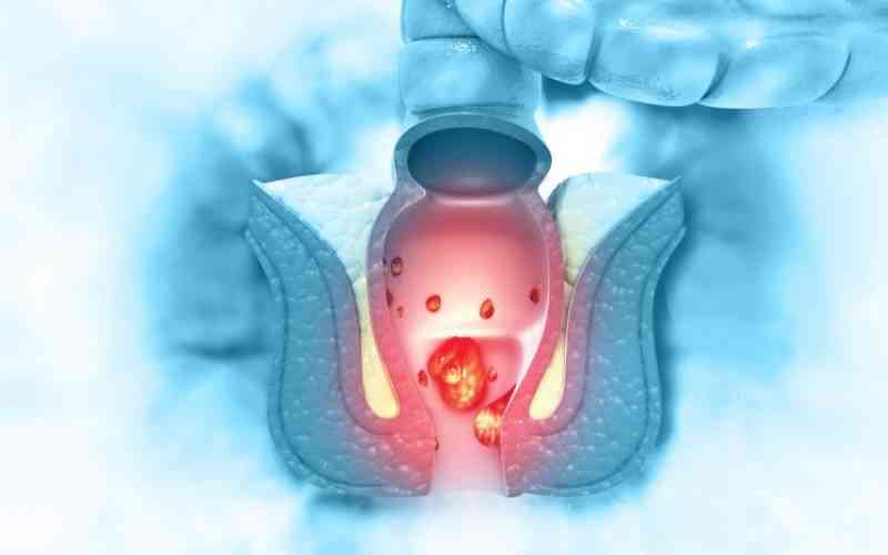 >New procedure cuts pain, recovery time for haemorrhoids patients