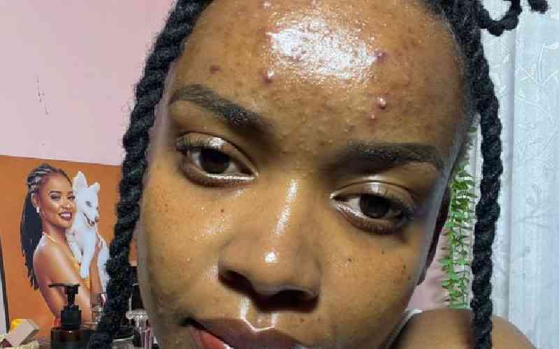 My acne story: Highs, lows and new-found self-love