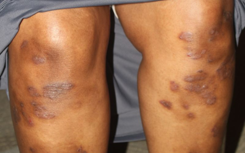 >More than a skin condition: The silent threat of psoriatic arthritis