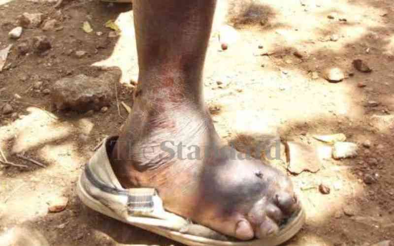 1,000 die of snake bites, scores left with permanent injuries