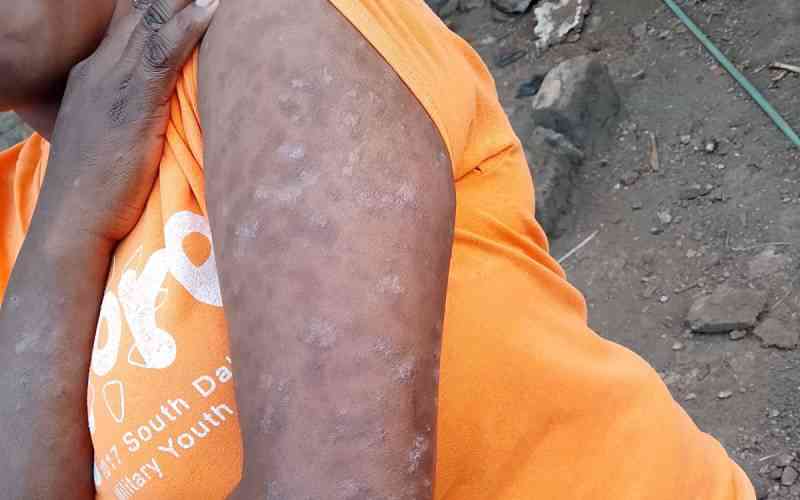 More than skin deep: Living a life full of confidence with psoriasis