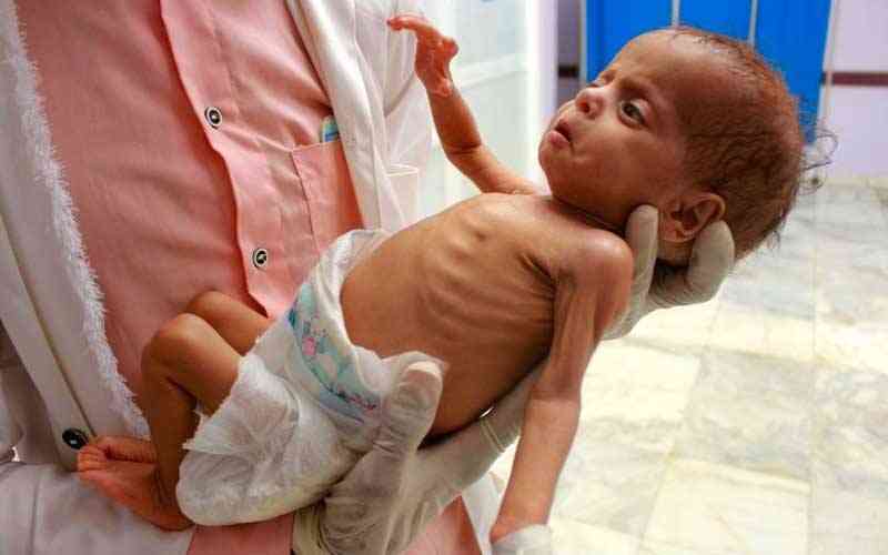 UN warns of surging child malnutrition in parts of Yemen