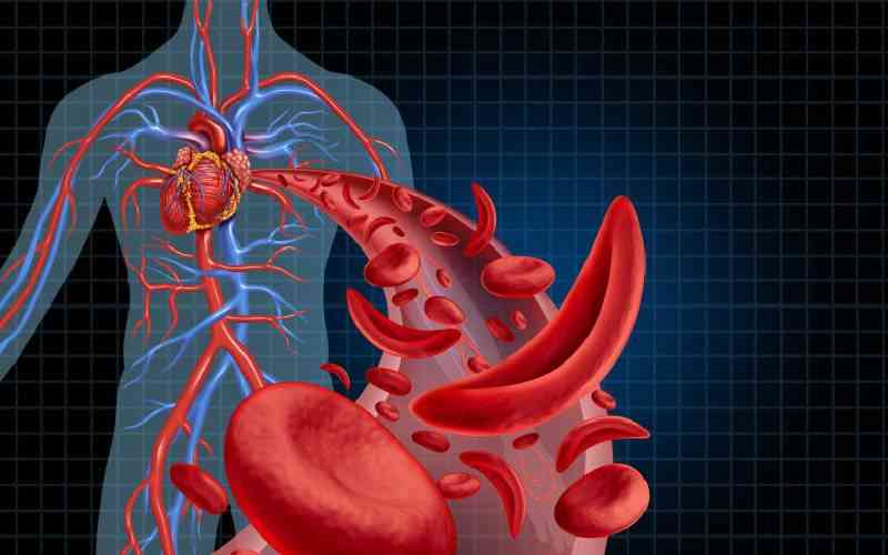 New hope for sickle cell warriors as Kisumu pioneers advanced treatment