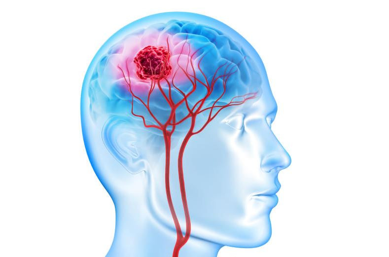 How a burst brain tumor changed DJ Muller's life forever