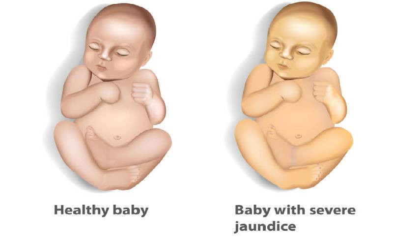 Jaundice: A common condition that requires medical attention in newborns