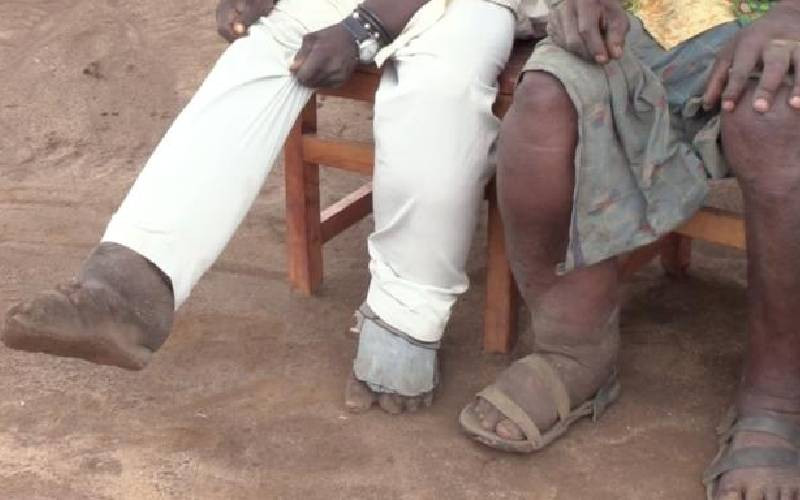 Elephantiasis: Silent tropical disease leaves poverty in its trail