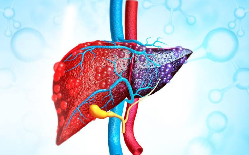 Liver transplant still unaffordable despite spiking cases