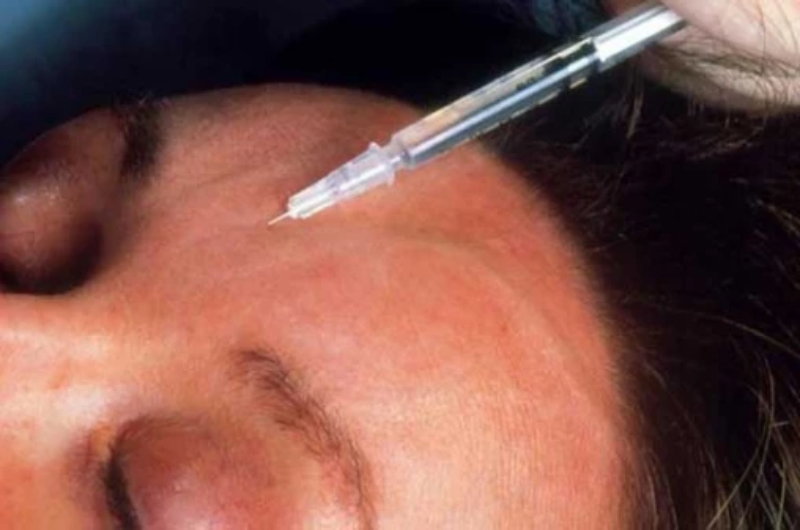  How age, expression and sleep combine to shape facial wrinkles over time