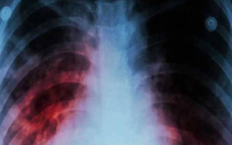 From back pain to paralysis: Understanding Spinal TB