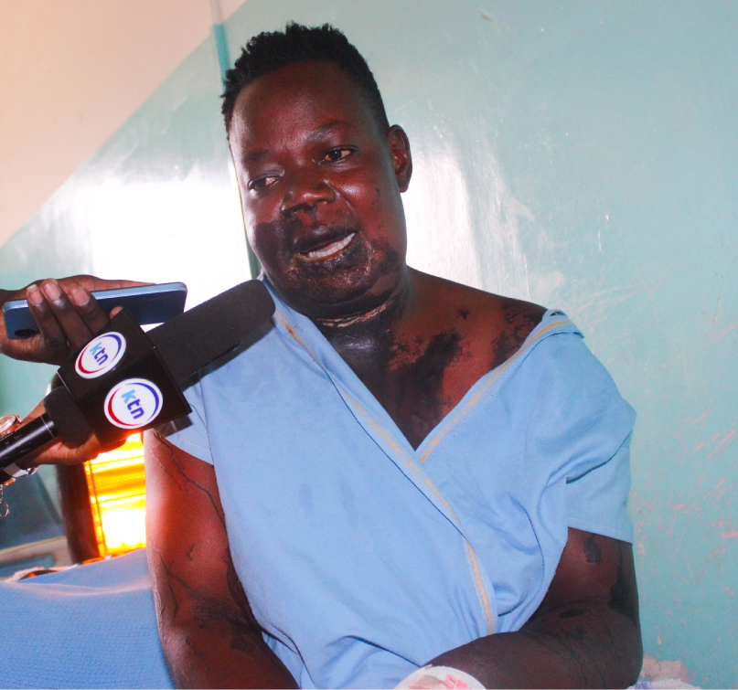 Woman fighting for her life seeks justice after brutal acid attack in Kisumu