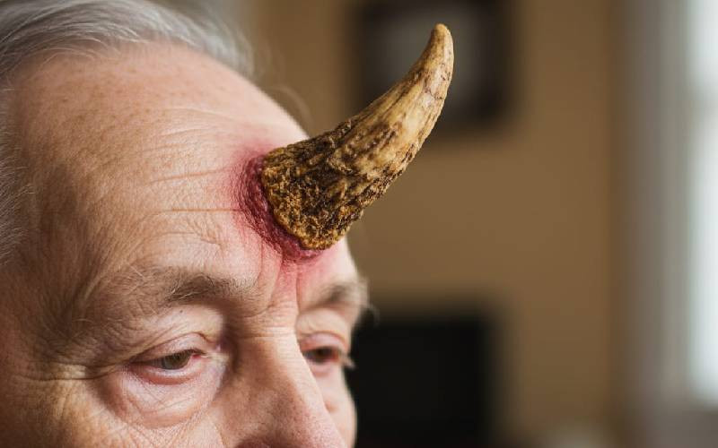 Kwa nini binadamu wengine humea pembe?