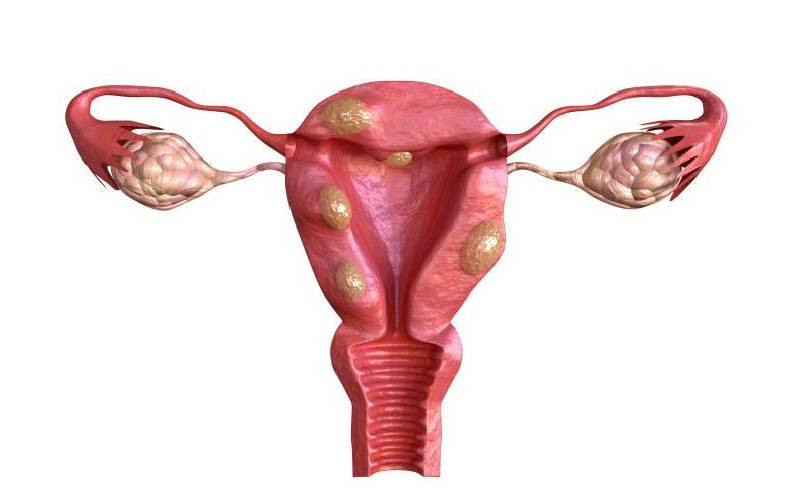 How fibroids deny many women motherhood