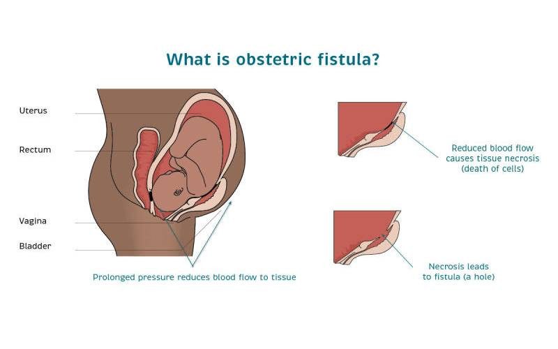 Women get second chance to live life fully after victory over fistula