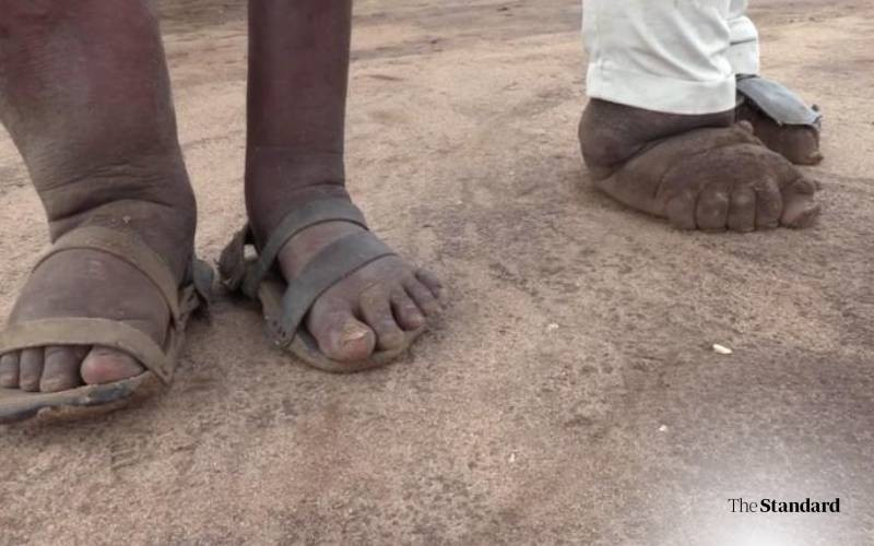 Fighting the invisible enemy: How NTDs harm Kenya's most vulnerable
