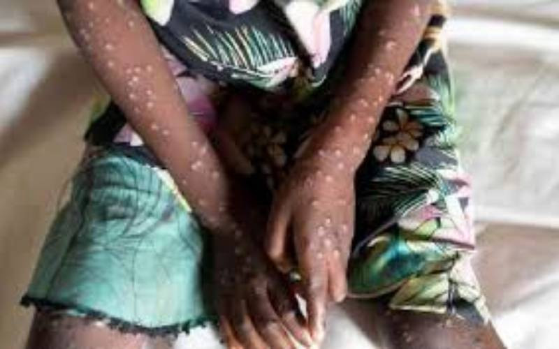 Five new Mpox cases confirmed in Kenya