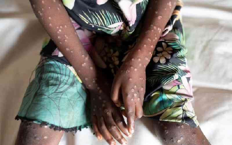 Truck driver tests positive for Mpox in Malaba