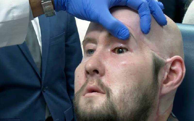 Man receives first eye transplant in step toward one day restoring sight
