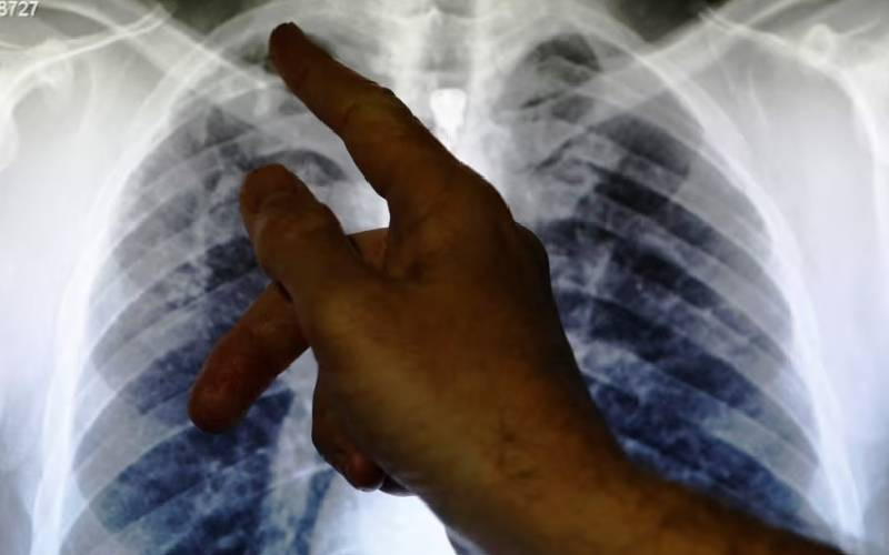 Tuberculosis remains one of world's deadliest diseases, but hope for vaccine rises