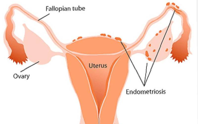 Shining a light on endometriosis: Time to listen and take action