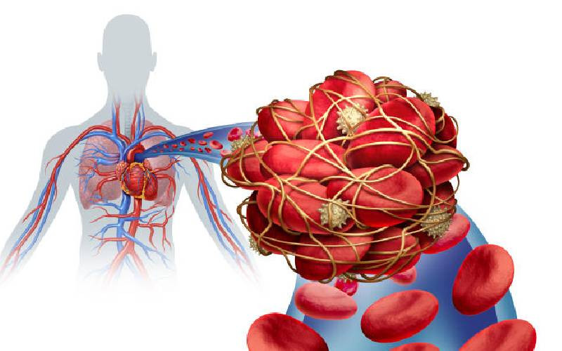 Blood clots in the lungs: Pulmonary embolism explained