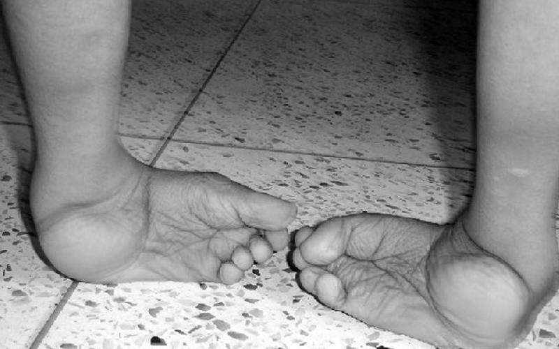 How families are rising above clubfoot stigma