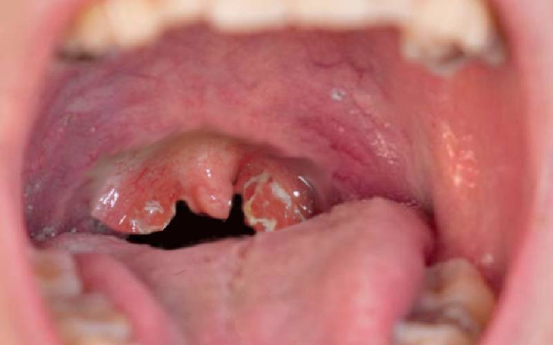 Adenoids: Hidden culprit behind recurrent coughs, loud snoring