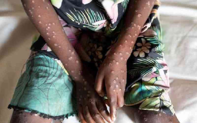 Mpox threat intensifies as new mutated strain spreads to China