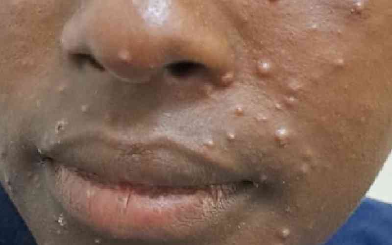 Kiambu County investigating suspected Mpox case